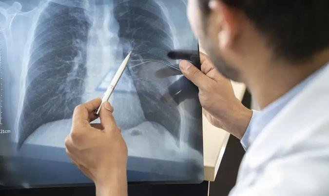 Segundo a Anvisa, o c�ncer de pulm�o figura como uma das principais causas de mortalidade pela doen�a no mundo(foto: Divulga��o)