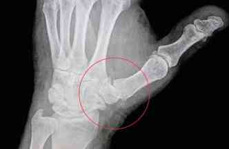 A artrose  um problema inflamatrio degenerativo que afeta as articulaes e provoca dor crnica. A boa notcia  que pode ser tratada sem o uso de cirurgias(foto: Hand411.com/Reproduo)