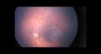 Imagem de fundo de olho de um beb mostra rea da retina afetada pelo zika vrus(foto: Agncia Fiocruz/Divulgao)