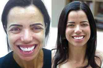 A fisioterapeuta Sheila Silene Soares antes e depois do tratamento para inibir a superexposio da gengiva: 