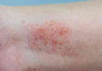 Durante os dias mais frios do ano, podem piorar os sintomas da dermatite atpica, uma das doenas de pele mais comuns(foto: Medscape.com/Reproduo)