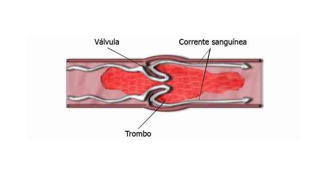 O trombo se forma porque o fluxo de sangue que desce ou sobe pode no conseguir voltar, gerando um acmulo nas vlvulas das veias(foto: Wikimedia/Reproduo)