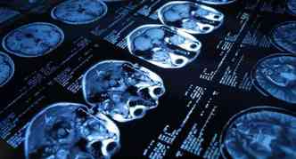 O aneurisma cerebral da paciente de Tocantins era to grave que chegou a ser detectado pelo exame de tomografia, o que  raro(foto: Wikimedia/Reproduo)