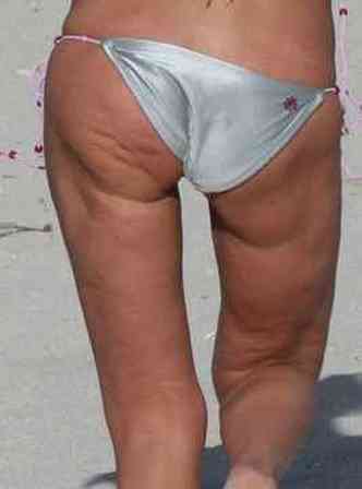 At pessoas famosas, como a atriz americana Tara Reid sofrem com as celulites nas ndegas e na perna(foto: Alyasfitclub.com/Reproduo)