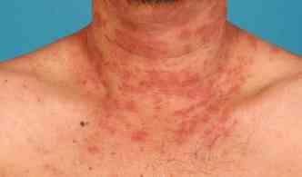 Muita gente confunde os sintomas da dermatite com a psorase, mas, a principal diferena entre elas  o formato das manchas na pele(foto: Asiaone.com/NSC/Reproduo)
