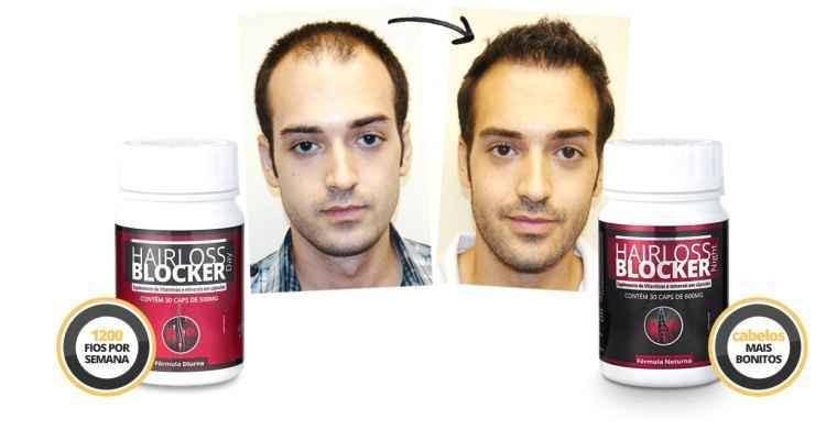 Hairloss Blocker/Reprodução Hairloss Blocker/Reprodução
