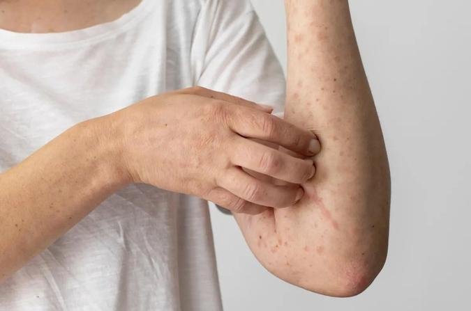 O sarampo está entre as doenças infecciosas mais transmissíveis, e a baixa cobertura vacinal atual deixa parte da população suscetível(foto: Freepik) O sarampo está entre as doenças infecciosas mais transmissíveis, e a baixa cobertura vacinal atual deixa parte da população suscetível(foto: Freepik)