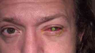 No faa como o americano Chad Groeschen, que dormiu com as lentes de contato, e acabou perdendo a viso do olho esquerdo(foto: Cincinnati Eye Institute/Reproduo)
