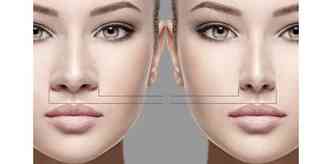Segundo artigo publicado no jornal cientfico JAMA Facial Plastic Surgery, a busca pela reviso da cirurgia plstica no nariz envolve alguns fatores, como a obstruo nasal(foto: Drjuan.com.br/Reproduo)