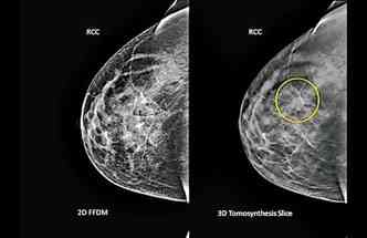 Imagem compara o diagnstico de tumor na mama pelo mtodo tradicional, a mamografia (esq.), e pela tomossntese, que proporciona maior visibilidade(foto: Breast-cancer.ca/Reproduo)