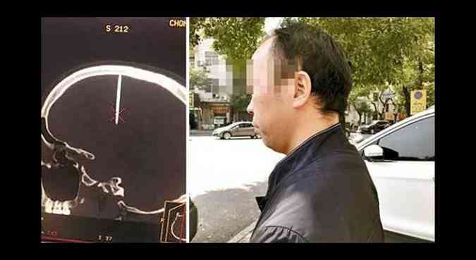 Um fato curioso ocorrido na China est chamando a ateno na internet: um prego de 4,8 cm apareceu fincado na cabea de um homem(foto: Sina/South China Morning Post/Reproduo)