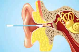Como explica o mdico americano, nunca se deve inserir o cotonete dentro do ouvido, para no empurrar a cera para o fundo e atrapalhar a audio(foto: YouTube/Tech Insider/Reproduo)