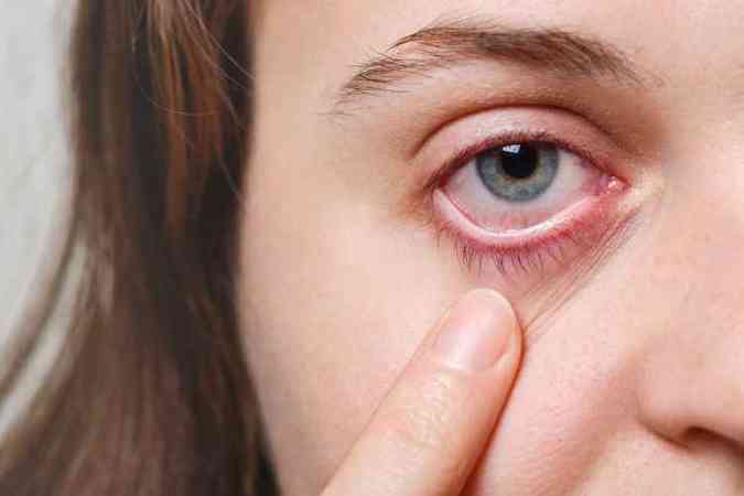 Segundo o oftalmologista Leonardo Gontijo, ao contrário do que se pode imaginar, lavar os olhos com água ou soro é uma das piores maneiras de combater a síndrome do olho seco(foto: Pixabay)