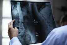 Osteoporose afeta 200 milhões de mulheres no mundo, calcula entidade