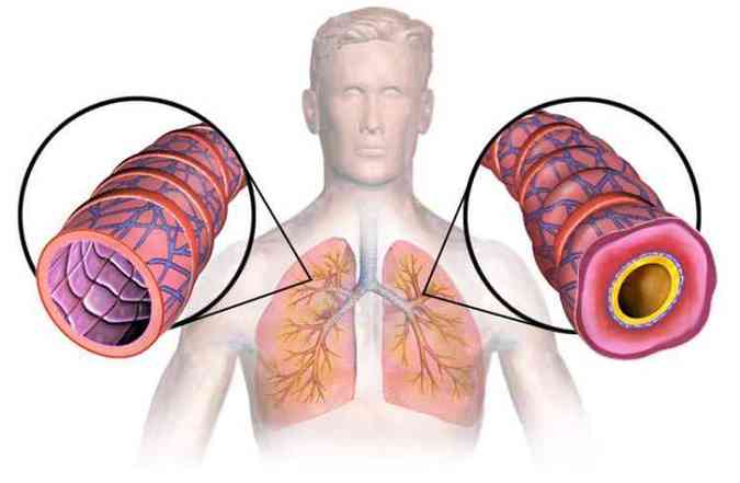 Comparativo entre o brnquio de uma pessoa normal (esq.) e o de um paciente com asma(foto: BruceBlaus/Drugdevelopment-technology.com/Reproduo)
