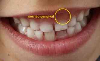 O sorriso  considerado gengival quando deixa aparecer mais de 4 mm da gengiva. Segundo o especialista, o problema  mais comum em mulheres(foto: Pixabay)