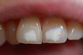 A fluorose, causada pelo excesso de flor no organismo, afeta crianas e pode causar de manchas brancas nos dentes a enfraquecimento da arcada dentria(foto: Lookfordiagnosis.com/Reproduo)