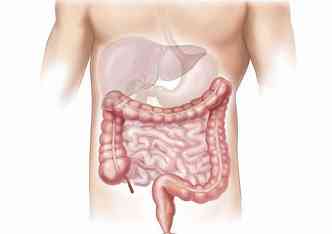 A Doena de Crohn  autoimune e  caracterizada pela inflamao dos intestinos, causada por uma reao do corpo s bactrias, boas ou ruins, que vivem no trato intestinal(foto: Pixabay)