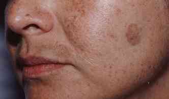 Os melasmas, que causam manchas escuras na pele, especialmente no rosto, no possuem uma causa definida, mas afetam mais as mulheres(foto: Bellezaslatinas.com/Reproduo)