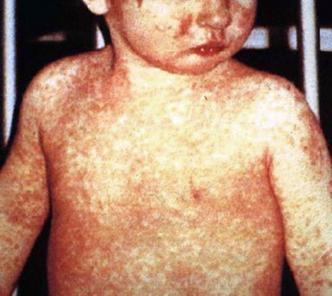 (foto: Wikimedia/CDC/NIP/Barbara Rice/Reprodução) (foto: Wikimedia/CDC/NIP/Barbara Rice/Reprodução)