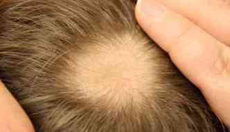 Segundo a dermatologista, a alopcia traz problemas apenas estticos, e pode ser revertida, j que no mata os poros capilares(foto: Onlinedermclinic.com/Reproduo)