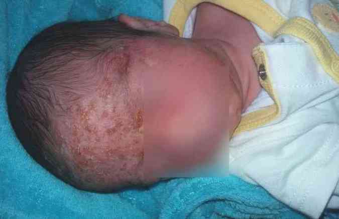 Com apenas 17 dias de vida, o beb Gustavo ficou com o rosto todo machucado pelo herpes zster, que foi adquirido aps receber um beijo(foto: Bebemamae.com/Facebook/Rafaela Moreira/Reproduo)