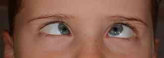 O estrabismo ocorre quando os msculos dos olhos deixam de agir em perfeito equilbrio e sincronia(foto: Pixabay)