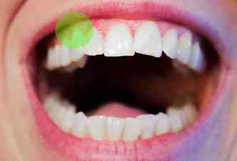 A retratao gengival e a perda de esmalte do dente so fatores que levam  sensibilidade dentria, o que causa muito sofrimento na hora de ingerir alimentos quentes, frios ou cidos(foto: Pixabay)