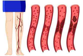 A trombose  a obstruo de um vaso ou artria, impedindo a circulao adequada do sangue. O trombo (cogulo) tambm pode se desprender e causar problemas mais srios(foto: Salud-1.com/Reproduo)