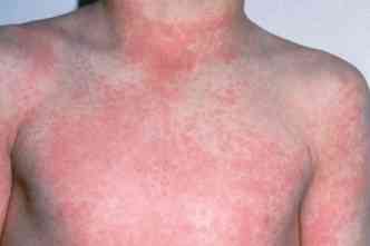 Um dos principais sintomas da escarlatina, doena causada por bactria e que causou um surto em colgio de Belo Horizonte, so manchas vermelhas na pele(foto: Divulgao)
