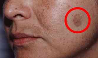 O melasma corresponde a manchas marrons de diferentes formas e tamanhos na pele, especialmente nas mulheres em idade frtil(foto: Portalrosachoque.com.br/Reproduo)
