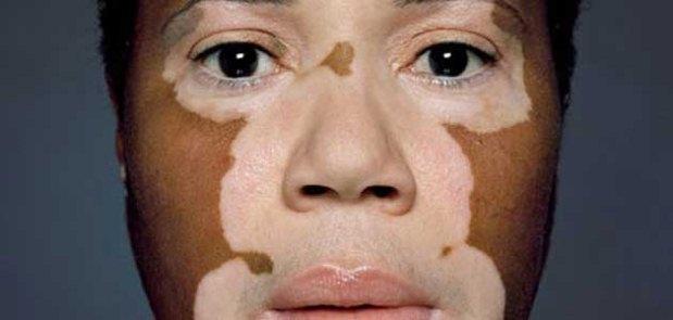 Comocurarvitiligo.com/Reprodução Comocurarvitiligo.com/Reprodução