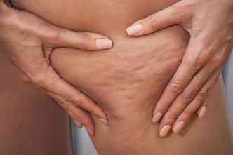 Diversos fatores, incluindo gentica e m alimentao, podem provocar o acmulo de gordura na pele, que leva  inflamao, mais conhecida como celulite(foto: Health.clevelandclinic.org/Reproduo)