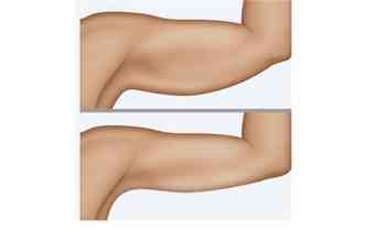 O lifting de brao, ou braquioplastia,  a retirada do excesso de pele, flcida, na parte de baixo do membro(foto: Ricardodetoni.com.br/Reproduo)