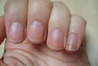  preciso ficar atento a qualquer alterao no aspecto das unhas, j que a infeco causada pelos fungos  de difcil tratamento(foto: Amberbaltics.com/Reproduo)