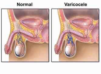A varicolece ocorre quando vasos sanguíneos de dentro do escroto acabam entupindo e formando 