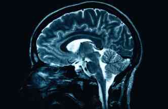 Por meio de um chip ligado diretamente ao crebro de pacientes no ltimo estgio da esclerose lateral amiotrfica, cientistas foram capazes de ler os pensamentos e fazer os doentes se comunicarem(foto: Infokid.org.uk/mri/Reproduo)
