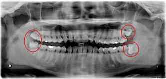 Segundo especialista, s nos casos em que os dentes do siso nascem de forma errada ou podem provocar infeces e outros problemas,  que a extrao  recomendada(foto: Wikimedia/Reproduo)