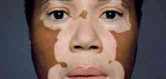Pesquisa americana associa o uso de medicamento contra a artrite para reverter a despigmentao causada pelo vitiligo(foto: Comocurarvitiligo.com/Reproduo)