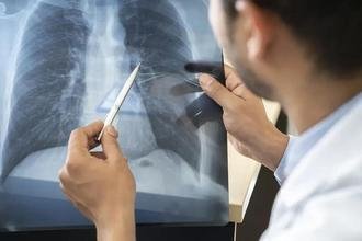 Anvisa aprova novo medicamento para c�ncer de pulm�o avan�ado