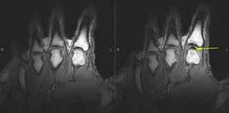 Na imagem da ressonncia,  direita,  possvel ver o afastamento do dedo durante o estalo, o que gera o barulho caracterstico e que aflige algumas pessoas(foto: University of Alberta/Divulgao)