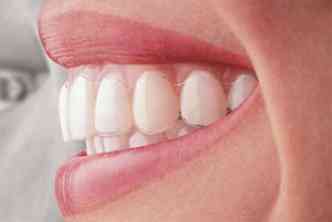 O Invisalign  quase imperceptvel e parece com os moldes usados no clareamento dos dentes(foto: Noveradental.com/Reproduo)