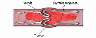 O trombo se forma porque o fluxo de sangue que desce ou sobe pode no conseguir voltar, fazendo com que o 'excesso' fique acumulado nas vlvulas das veias(foto: Wikimedia/Reproduo)