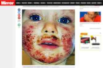 Sienna Duffield, de 3 anos, passou por um tratamento de 8 meses aps sofrer com os ferimentos causados pelo herpes, que pode ter sido transmitido por um adulto que a beijou no rosto(foto: Mirror.co.uk/Reproduo)