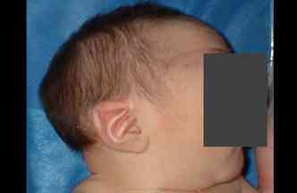 Crianas com microcefalia nascem com o crnio bem menor que o normal, que  de 33 cm(foto: En.atlaseclamc.org/Reproduo)