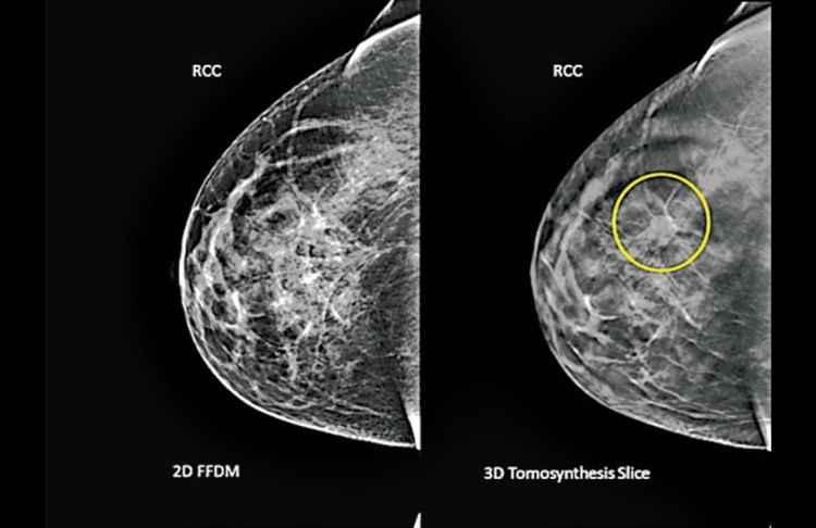 Breast-cancer.ca/Reprodução Breast-cancer.ca/Reprodução