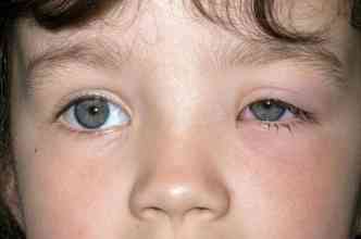 A celulite orbitria  uma doena ocular que pode ser causada pela sinusite e afeta principalmente as crianas(foto: Babycenter.com/Reproduo)