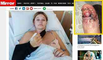 Depois de ficar roendo a unha do polegar demasiadamente, a australiana Courtney Whithorn acabou adquirindo um cncer raro que levou  amputao do dedo(foto: Mirror.co.uk/Reproduo)